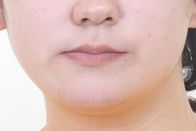 부산구순구개열