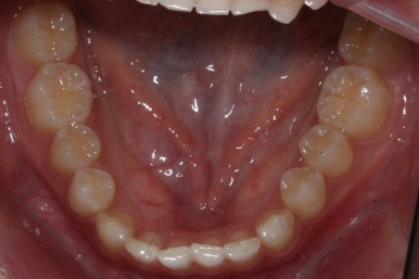 부산매복치아교정