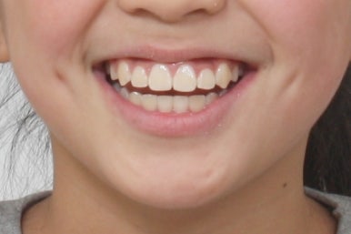 연산동덧니교정