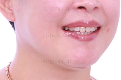 동래임플란트교정