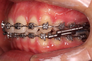 부산연산동치아교정