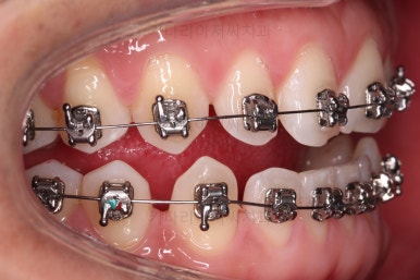 연산동임플란트