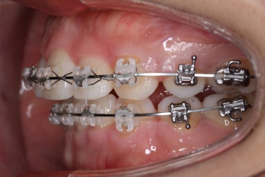 부산연산동교정치과