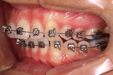 부산연산동치아교정