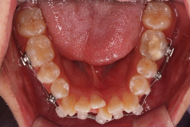 부산청소년치아교정