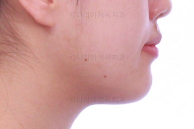 부산비발치교정