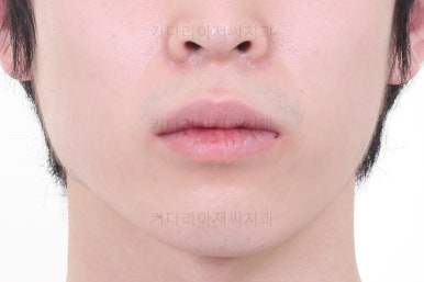 부산돌출입교정