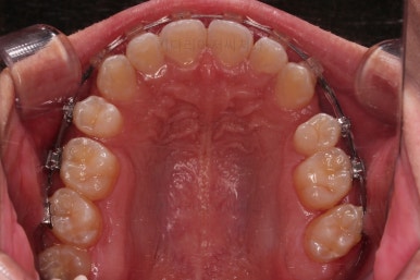 부산청소년치아교정