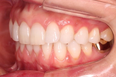 연산동부분교정