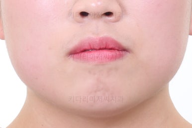 부산비발치교정