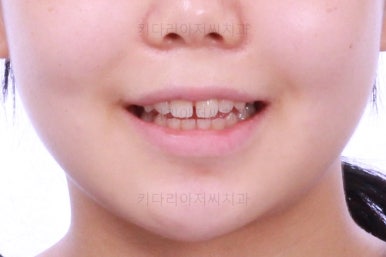 부산앞니벌어짐교정
