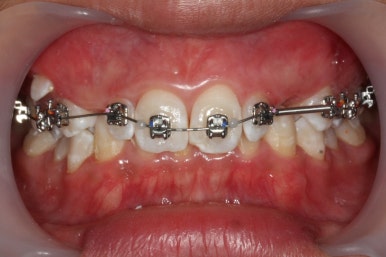 부산왜소치교정