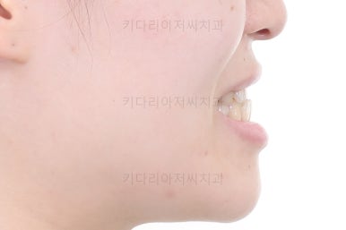 부산치아교정추천