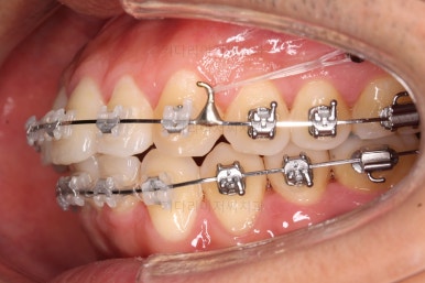 부산교정치과추천