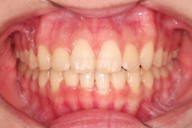 부산비발치교정