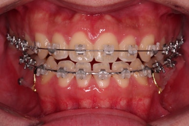 부산주걱턱교정