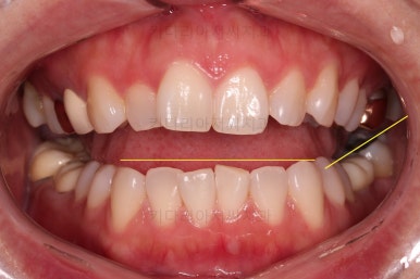 부산부분치아교정