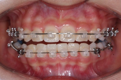 부산치아교정잘하는곳