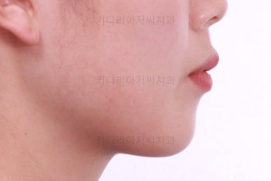 부산앞니부분교정