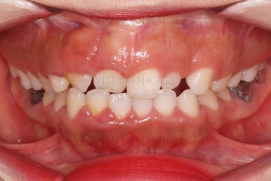 부산구순구개열