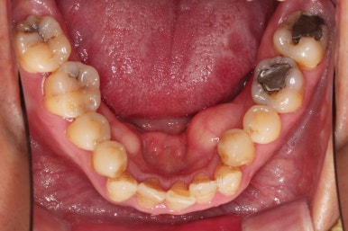 부산구순구개열교정