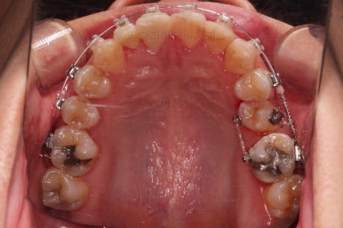 연산동치아교정