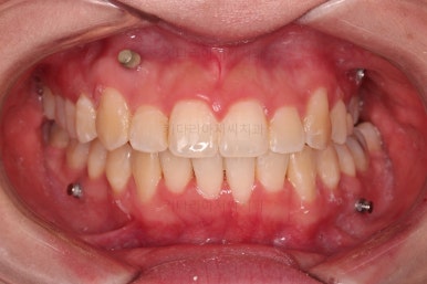 부산비대칭교정