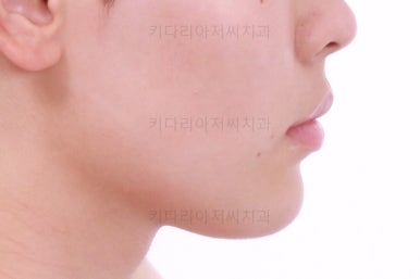 부산연산동치아교정