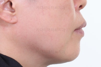 동래임플란트교정