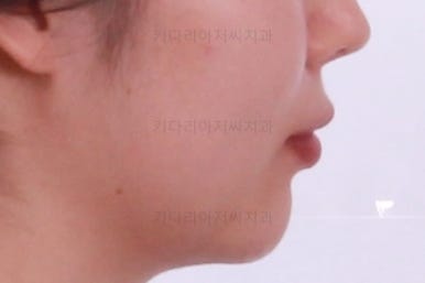 부산부분치아교정