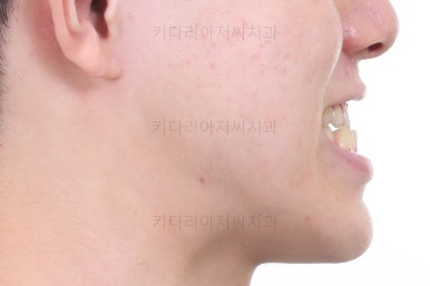 부산주걱턱교정