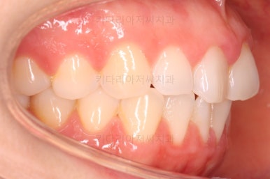 부산나비앞니교정