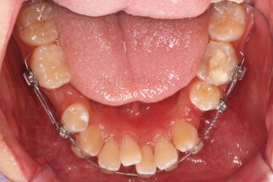 부산청소년치아교정