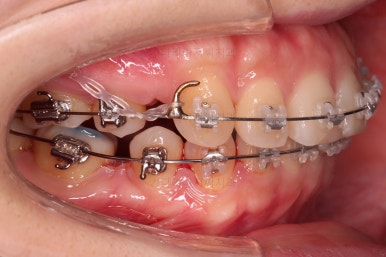 부산연산동교정치과