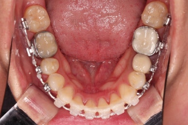 부산사랑니교정