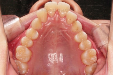 연산동치아교정