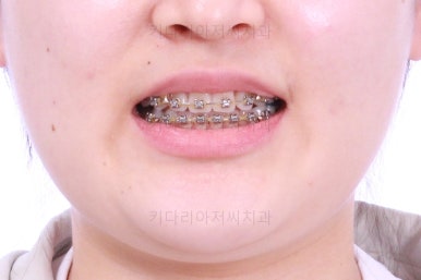 부산치아교정