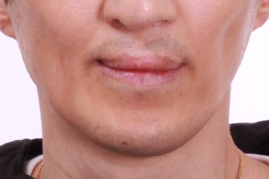 부산구순구개열교정