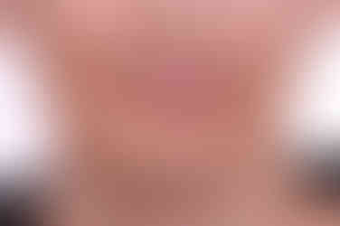 부산구순구개열교정