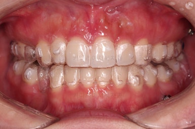 부산인비절라인