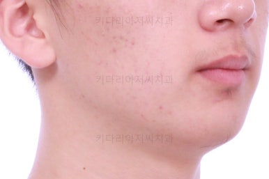 부산청소년치아교정