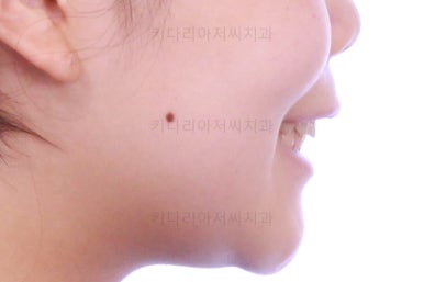 부산앞니벌어짐교정