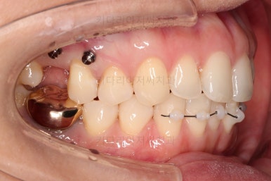 부산치아교정비용