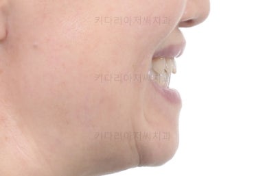 부산치아교정잘하는곳