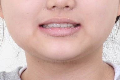 연산동치아교정