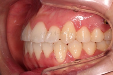 부산비발치교정