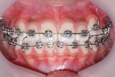 연산동덧니교정