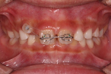 부산어린이돌출입교정