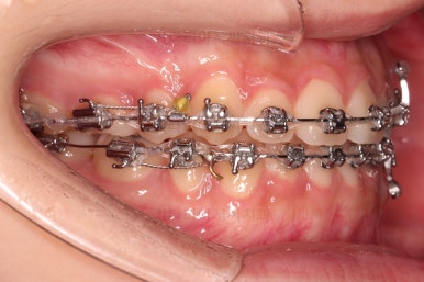 동래구치아교정