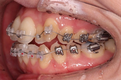 부산치아교정잘하는곳